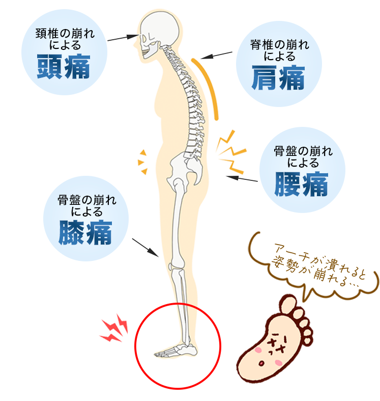 足のアーチが潰れると全身の歪みにつながります。
